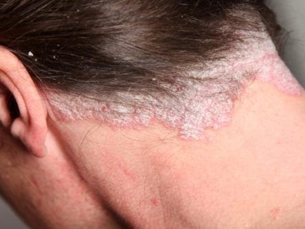 bőrrák vörös foltok formájában Rodionova pikkelysömör kezelése