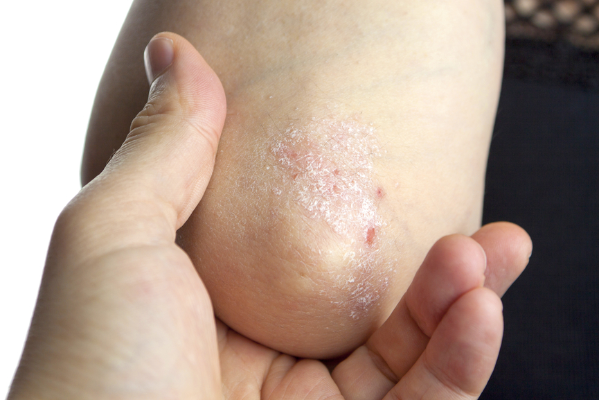 A tenyérizzadás és lábizzadás bőrgyógyászati kezelése